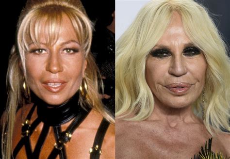 que le paso a donatella versace en la cara|Fotos del antes y después de todas las cirugías de Donatella .